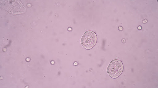 What Are Epithelial Cells in Urine