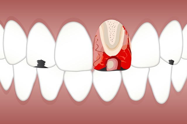 All you need to know about enamel erosion and its treatment